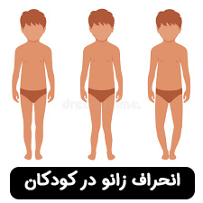 انحراف زانو در کودکان