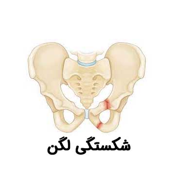 علائم شکستگی لگن