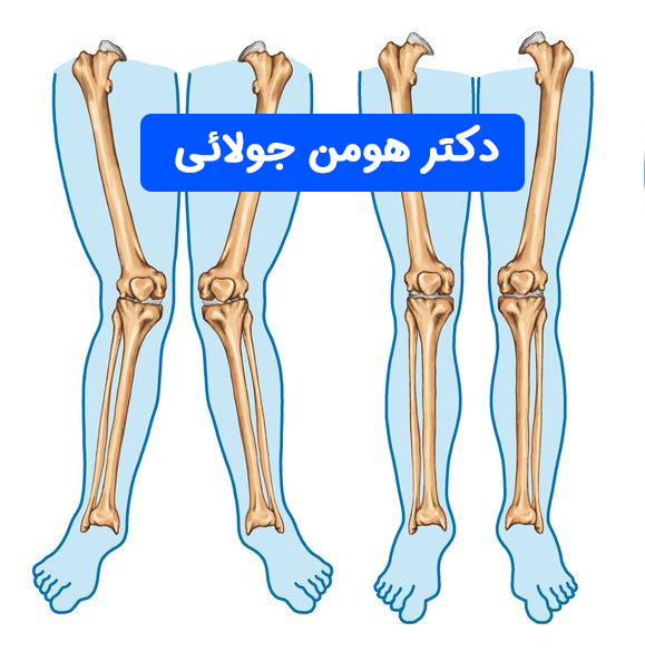 انواع انحراف زانو