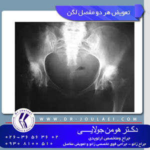 تعویض هر دو مفصل لگن