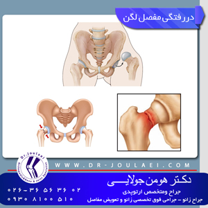 دررفتگی-مفصل-لگن