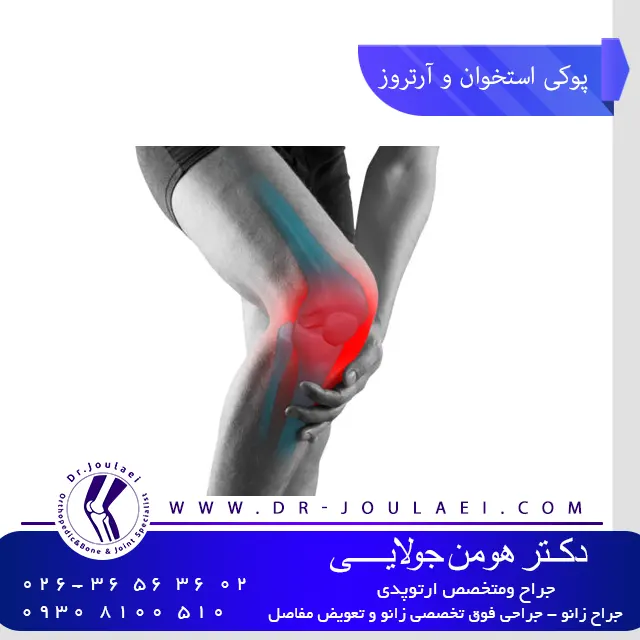 درمان آرتروز زانو و پوکی استخوان