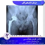 لگن-شکسته