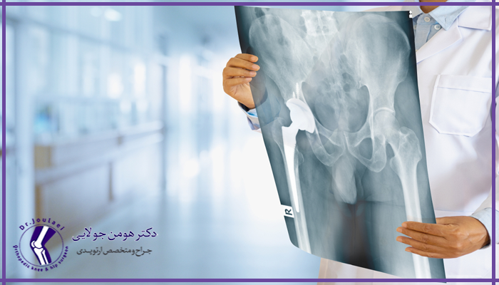 نکات بعد از تعویض مفصل لگن